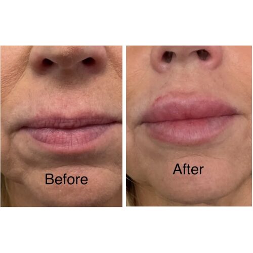 Lip augmentation results shown