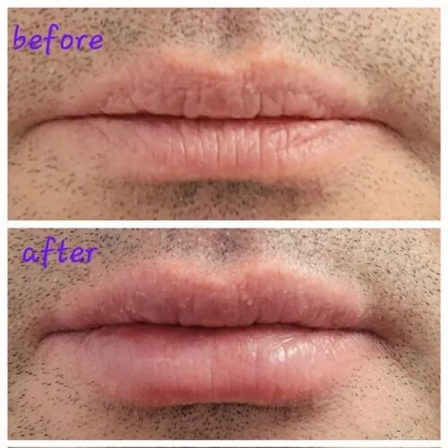 Lip treatment results shown