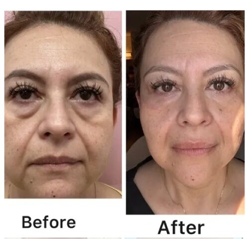 Before and after skincare treatment comparison.