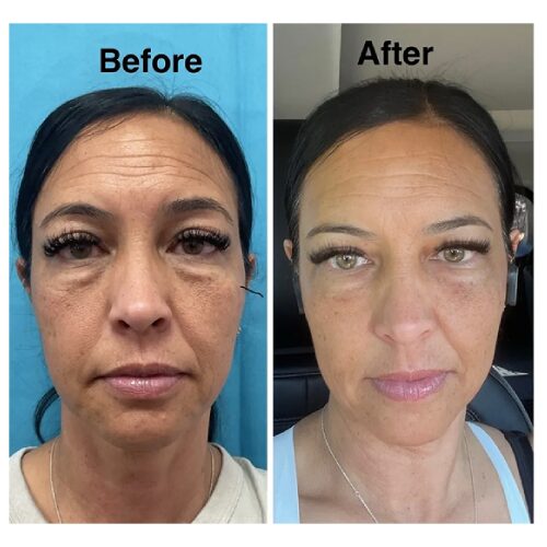 Before and after comparison of woman's face.